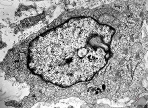 M,15y. | eosinophilic granuloma - Langerhans cell M,15y. | eosinophilic granuloma - Langerhans cell